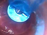 Endoscope POV: Test Tube Cock Urethral Insertion